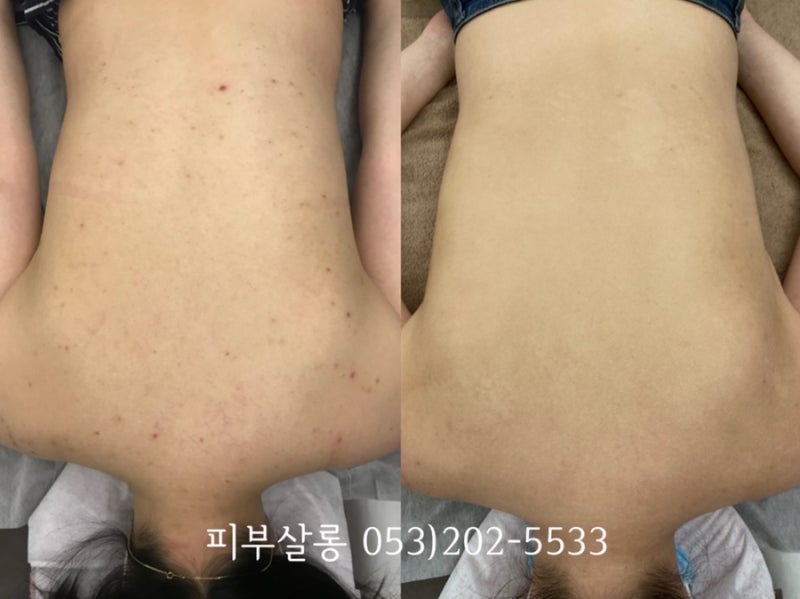 대구피부관리실)달서구 알라딘필링팔여드름자국재생케어리뷰/죽전동피부관리실 2