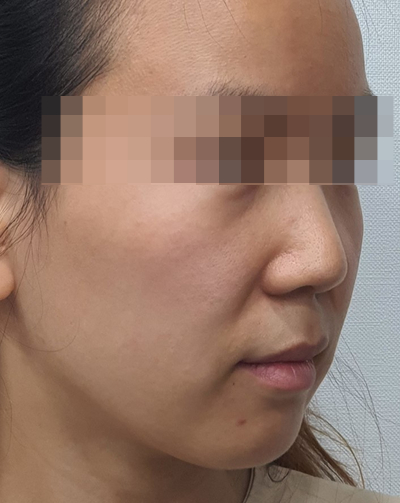  [부천성형외과 Dr. 김 칼럼]부천에서도 튠리프팅을 이용한 얼굴의 라인 정리 및 리프팅을