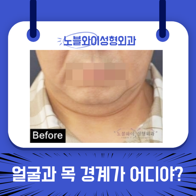  이중턱레이저 받았지만 지금은