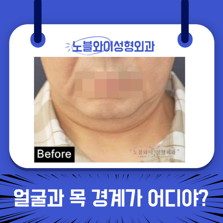 이중턱레이저 받았지만 지금은