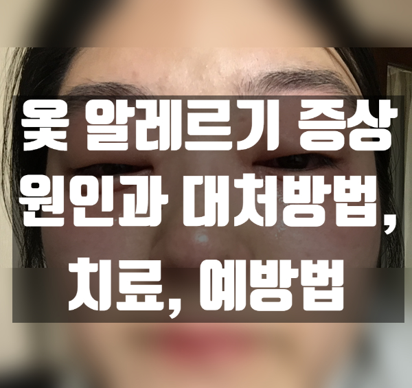 옻 알레르기 원인과 증상 완화 방법, 치료 및 예방법