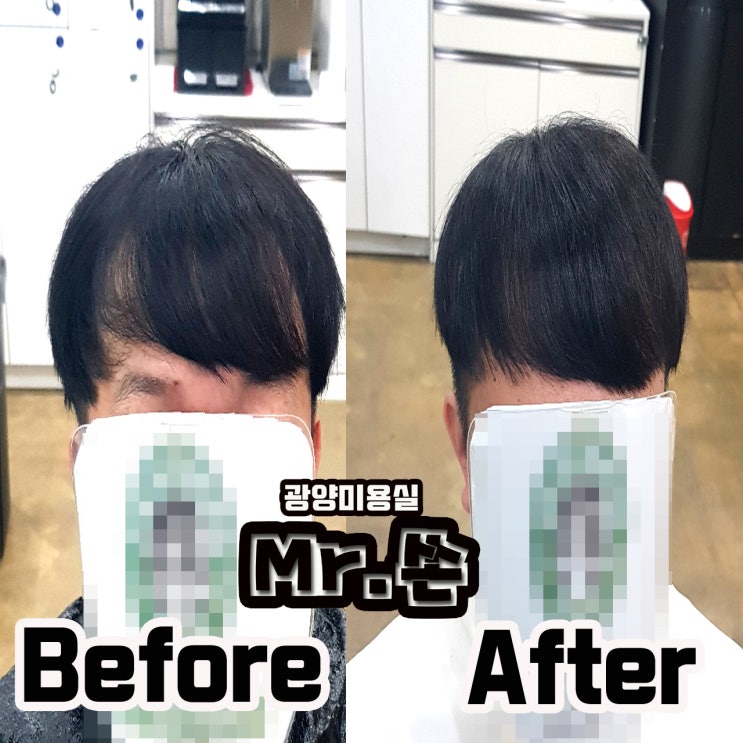  모류교정 으로 벌어지는 머리 잡으면 어떻게 변할까요??
