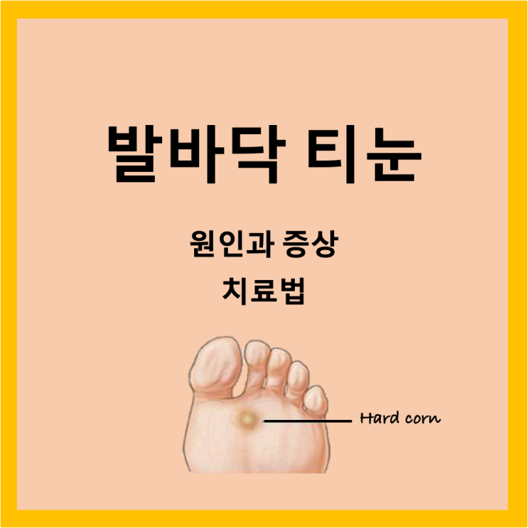 약국 티눈밴드로 발바닥 티눈 제거하기