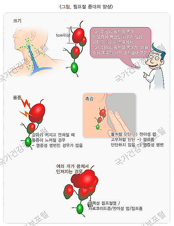 림프절(임파선)염 증상, 치료법 알아보기 : 네이버 블로그