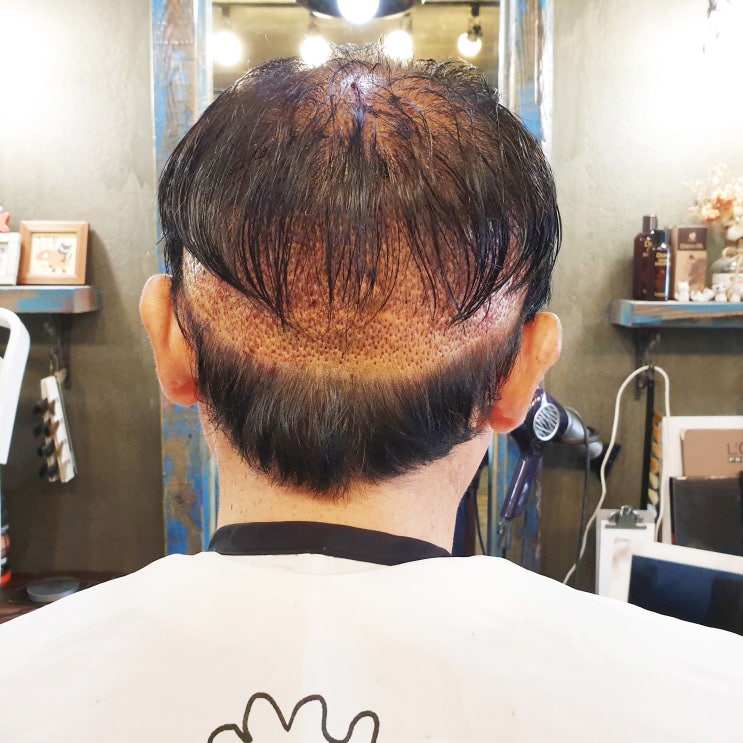  모발이식 붙임머리로 후두부 가려요