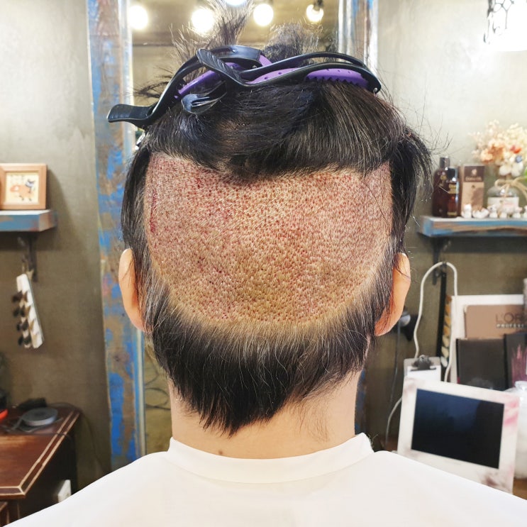 머리카락 이식 후 뒷머리 부분가발 헤어 디자인