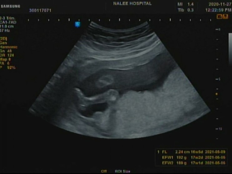 남편이 쓰는 임신일기 [9] (임신 16주 - 2차 기형아검사(정신지체,다운증후군), 성별확인)
