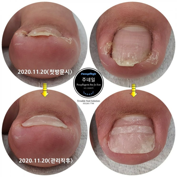 중3 남학생의 살을찌르는 고통 염증발톱관리/분당용인수원수지보정동백죽전동/주네일/무좀파고드는내향성발톱손톱변형전문네일살롱