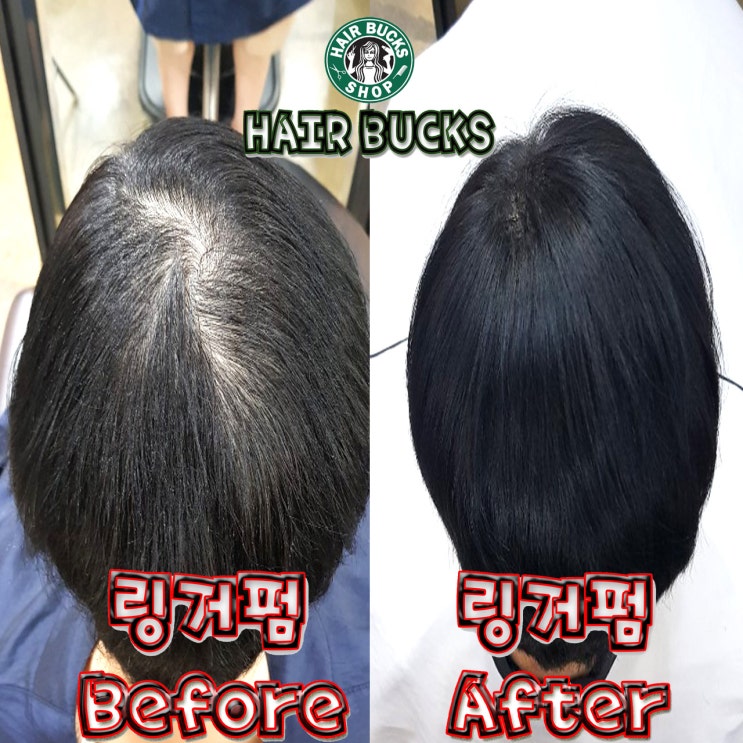  가마교정 시술받으시면 놀라운 효과를 보게 되십니다 !!