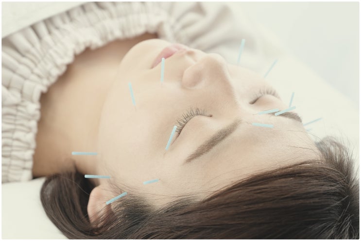  부산 매선침, 부작용 과연 없을까?