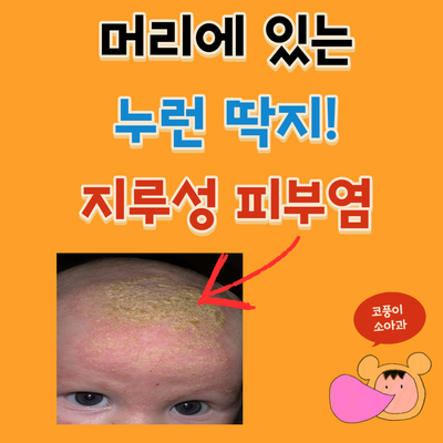  머리에 있는 누런 딱지는 뭔가요?(아기 지루성 두피염, 지루성 피부염)