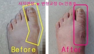  다양한 무지외반증의 개인맞춤형 치료방법