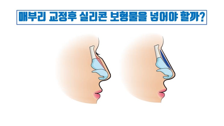  매부리코성형 시 매부리코보형물을 삽입해야 할 이유 전혀 없어요!!!