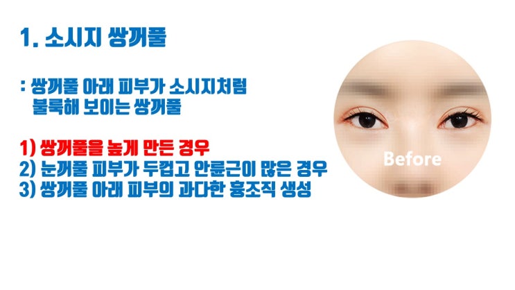  쌍수 높은 라인 반드시 쌍수소시지와 꺾인 쌍꺼풀 둘 중 하나