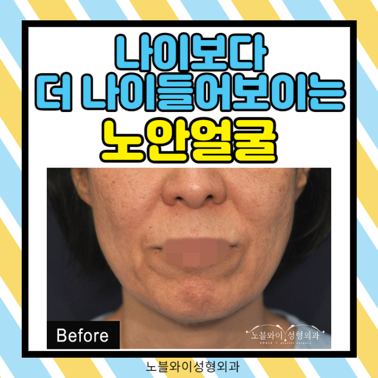  처진얼굴성형 왜 안면거상술 할까