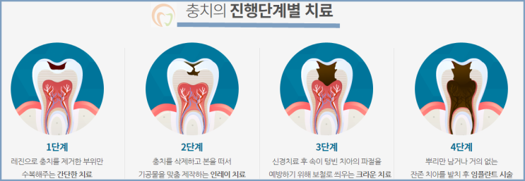  충치의진행단계별치료방법정리