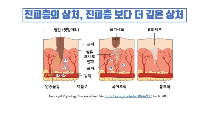  흉터 없는 앞트임, 비절개 앞트임 단연코 거짓말입니다. !!!