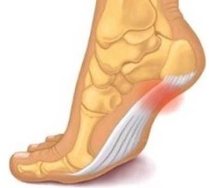  족저근막염  원인,증상, 자가치료방법
