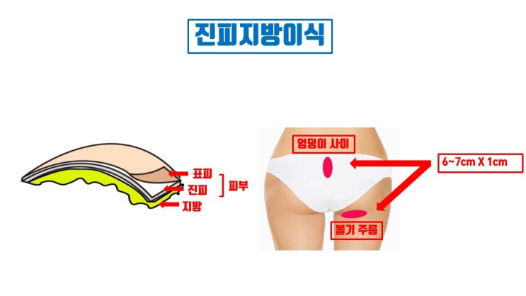  무보형물 코수술에 생각보다 자가진피 많이 사용되지 않아요.