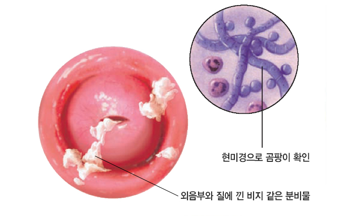  조금만 피곤하면 생기는 ‘여성의 감기’, 질염 관리 (냉, 대하, 분비물, 질 가려움, 냄새)