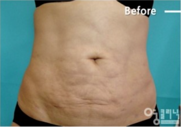 [강남지방흡입 부작용 복부지방흡입유착 강남다이어트클리닉] 이오팻주사 3