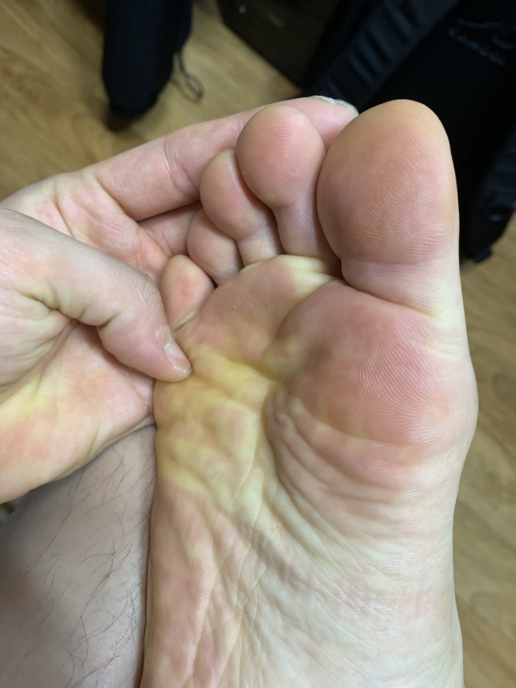  무좀 습진에 좋은 일회용 무좀치료제 엑소데릴 크림