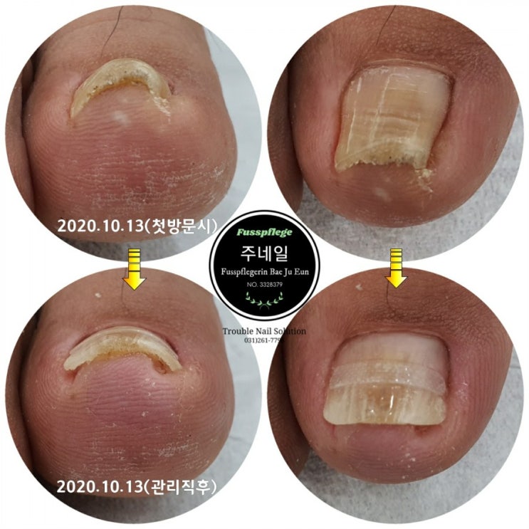 파고들은 발톱때문에 골프 피니쉬할때 너무 아파요../분당용인수원수지보정동백죽전동/주네일/무좀파고드는내향성발톱손톱변형전문네일살롱 파고들은 발톱때문에 골프 피니쉬할때 너무 아파요../분당용인수원수지보정동백죽전동/주네일/무좀파고드는내향성발톱손톱변형전문네일살롱
