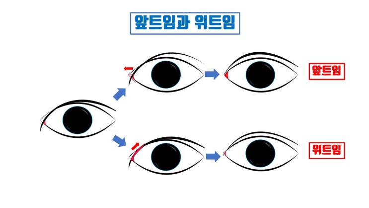  심한 앞트임 누호 노출 피하려면 윗트임을!!!