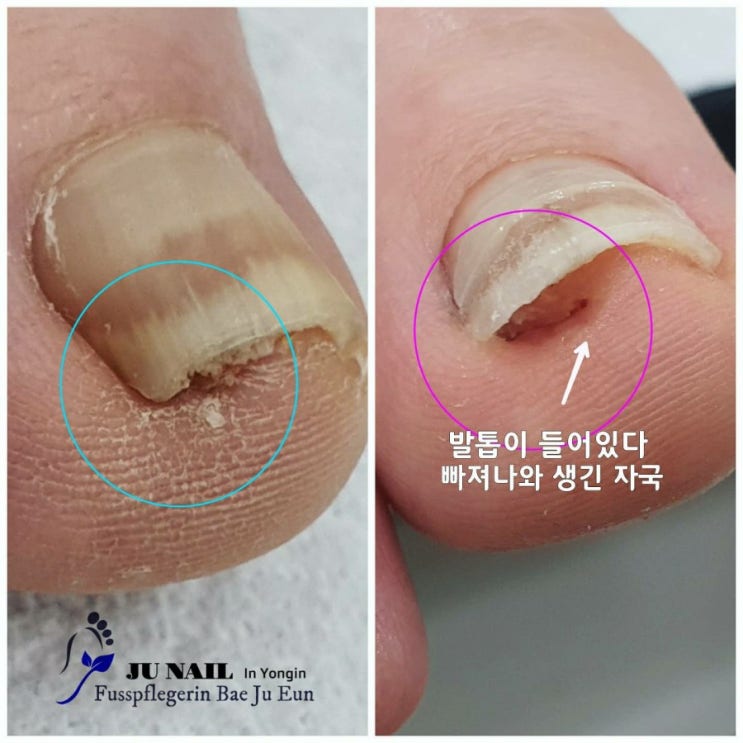 뾰족한걸로 파내면서 파고들어 아프고 두꺼워진 발톱을 참아왔던 어머님/분당용인수원수지보정동백죽전동/주네일/무좀파고드는내향성발톱손톱변형전문네일살롱