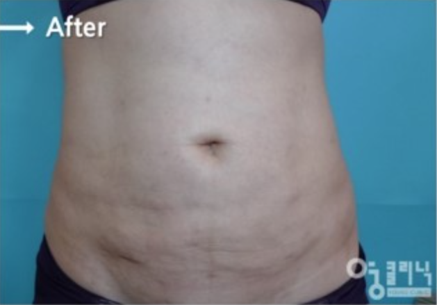 [강남지방흡입 부작용 복부지방흡입유착 강남다이어트클리닉] 이오팻주사 11