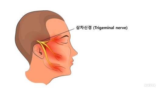  한쪽얼굴만 통증이?  삼차신경통 이라고 들어보셨어요?