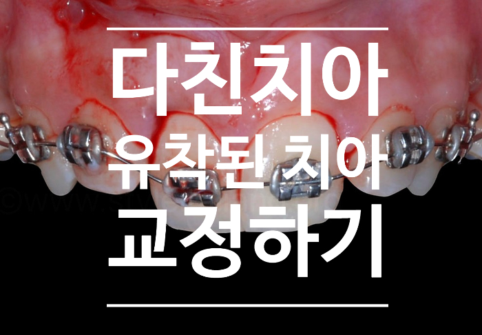 다친치아도 교정이 가능한가요? 유착된치아(ankylosis)가 있는 경우 교정을 하는 방법 - 미사교정치과 다친치아도 교정이 가능한가요? 유착된치아(ankylosis)가 있는 경우 교정을 하는 방법 - 미사교정치과