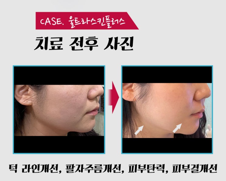 피부탄력을 위한 울트라스킨 플러스 리프팅
