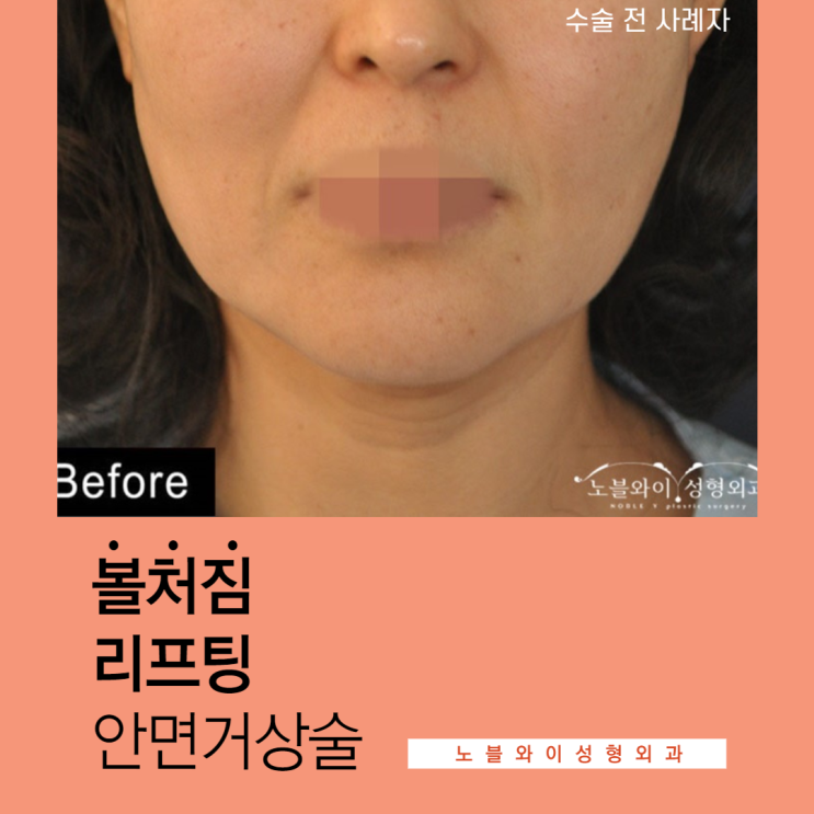  볼처짐리프팅 안면거상술로 좋아질까