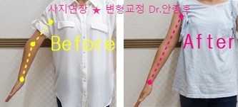  휘어진 팔 수술후기