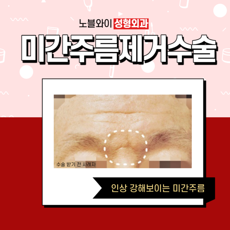  미간주름제거수술 동시에 눈과눈썹사이 거리 넓어짐