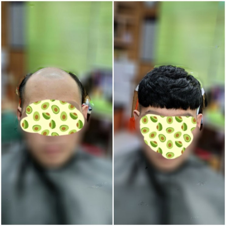  2년째 헤어이식커버증모로   탈모해결! 춘천가발 보톡스증모전문점(30대 남성편)