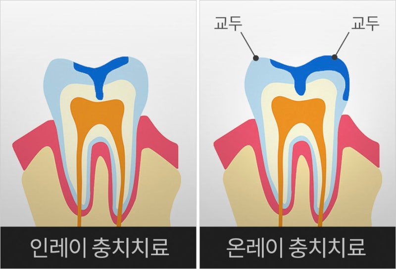 평내호평역치과의원 인레이와 온레이 우식 치료의 차이점