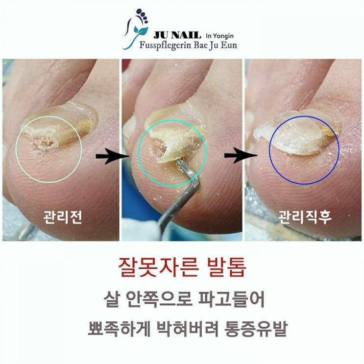 야구공에 맞은발톱때문에 2년넘게 아픈발톱으로 살았어요./분당용인수원수지보정동백죽전동/주네일/무좀파고드는내향성발톱손톱변형전문네일살롱