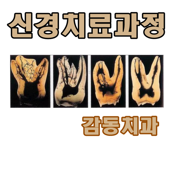  당감동감동치과신경치료과정정리