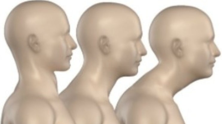  수험생의 척추질환-거북목, 척추측만증, 근막동통증후군