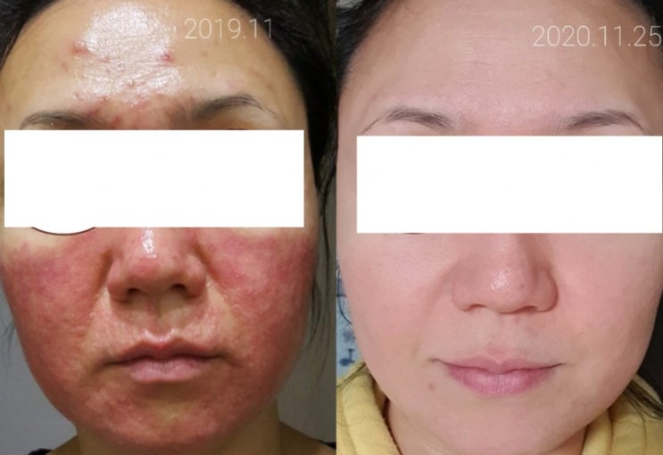  주사피부염증상 시작될때 연고사용말고 시아로하세요