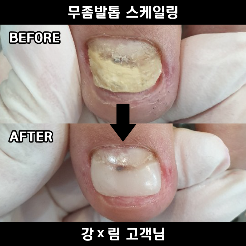 발톱무좀관리는 경기 시흥 페디아이티엔에서 빠른 해결!