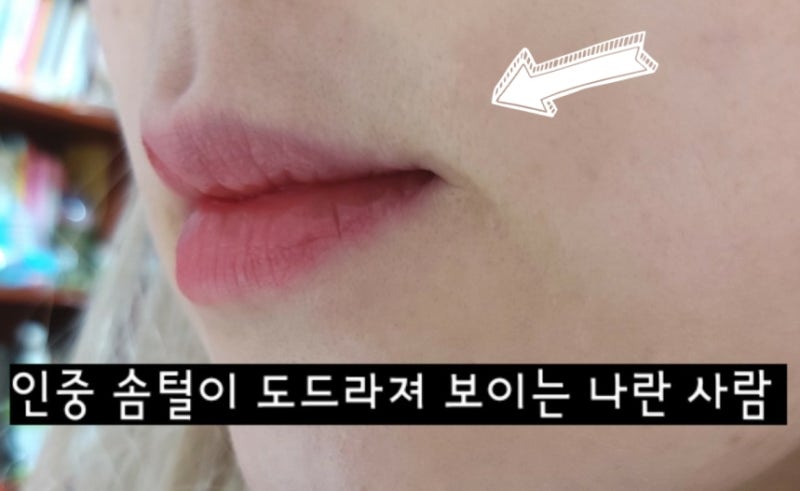 피부과 남성 수염 레이저 제모 주기 가격 인중 탈모 턱모낭염없음 3차 3주후기 스플렌더X추천 2