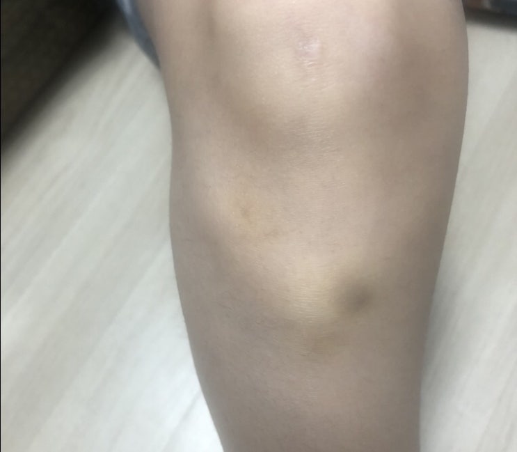  무릎 물참 증상과 무릎의 진짜 건강을 위해서는?