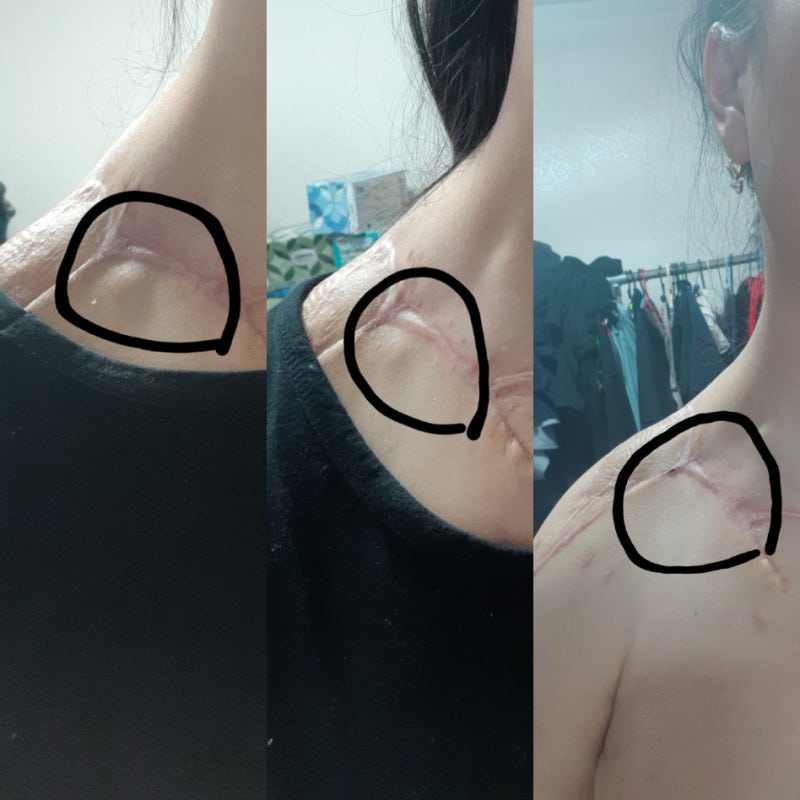 골육종, 육종암 재발 전이 항암제, 면역항암제 임상 그후 1년