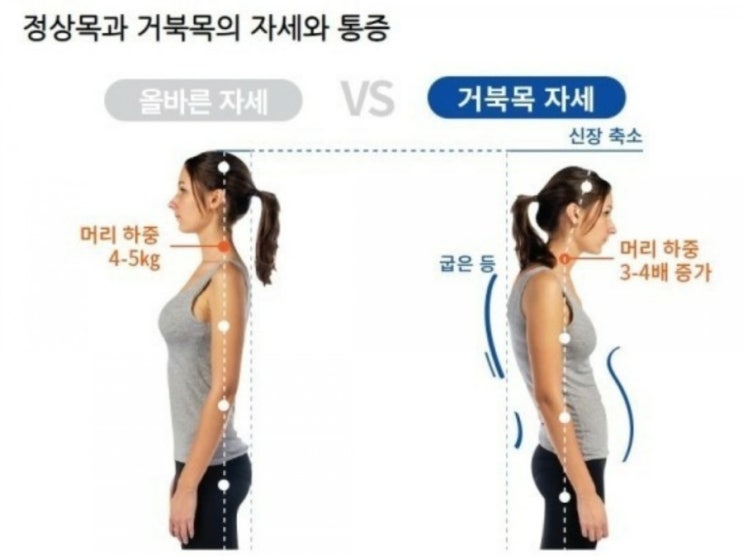  광안리 어깨뭉침, 팔저림, 두통-부산거북목, 일자목(자가진단)