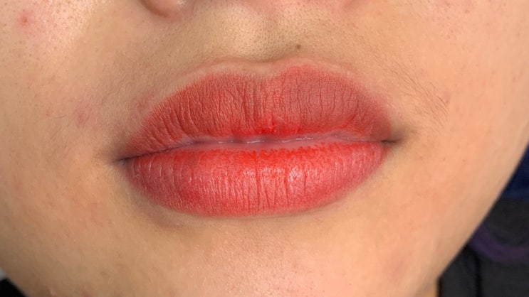 서울강남 입술 색소침착 검은입술 해결 방법