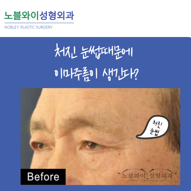  이마거상술잘하는곳 눈처짐수술 경험이 중요