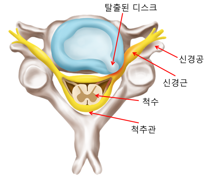  일산, 목 아프고 팔 저려요, 목디스크, 경추 추간판 탈출증 - 가로세로 한의원 일산점
